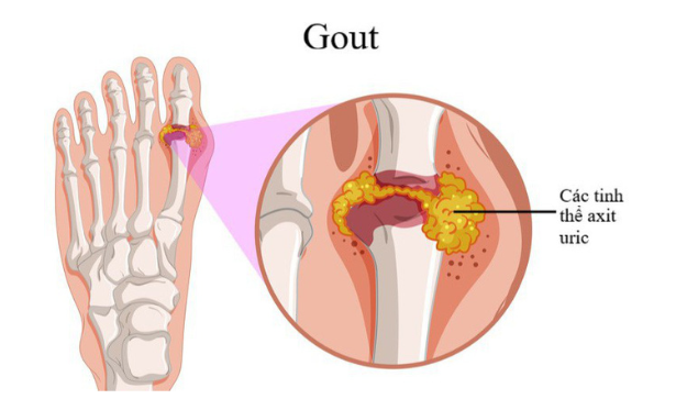 3 loại thảo dược trị gout hiệu quả hàng đầu hiện nay đều có mặt trong Cốt Bách Bổ
